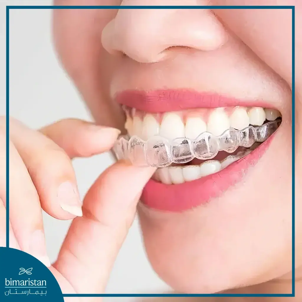 Treating Open Bite Using Clear Aligners In Istanbul