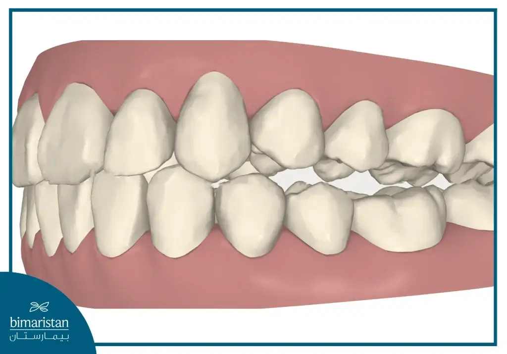 Open Bite Treatment For Back Teeth In Turkey