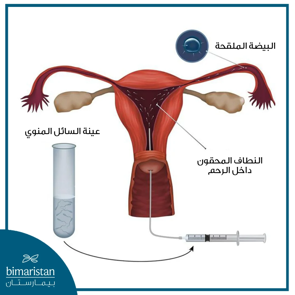 عملية الحقن داخل الرحم والتي تعد من أول الخيارات التي يلجأ إليها الزوجين الذين يعانون من العقم