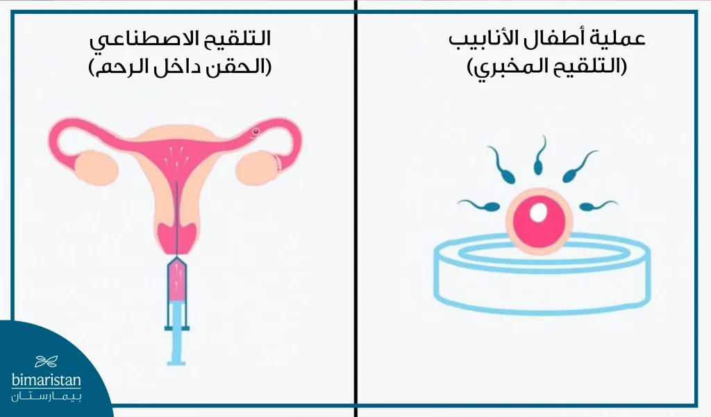 مقارنة بسيطة بين الحقن داخل الرحم وعملية أطفال الأنابيب التي تجرى في تركيا