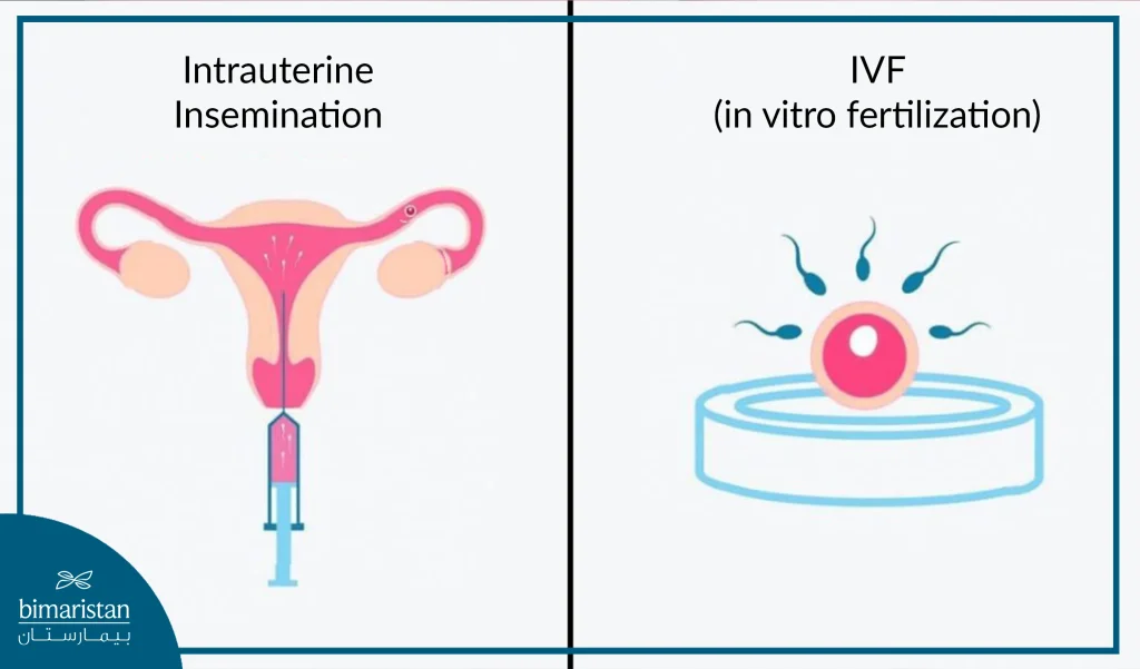 A Simple Comparison Between Iui And Ivf In Turkey