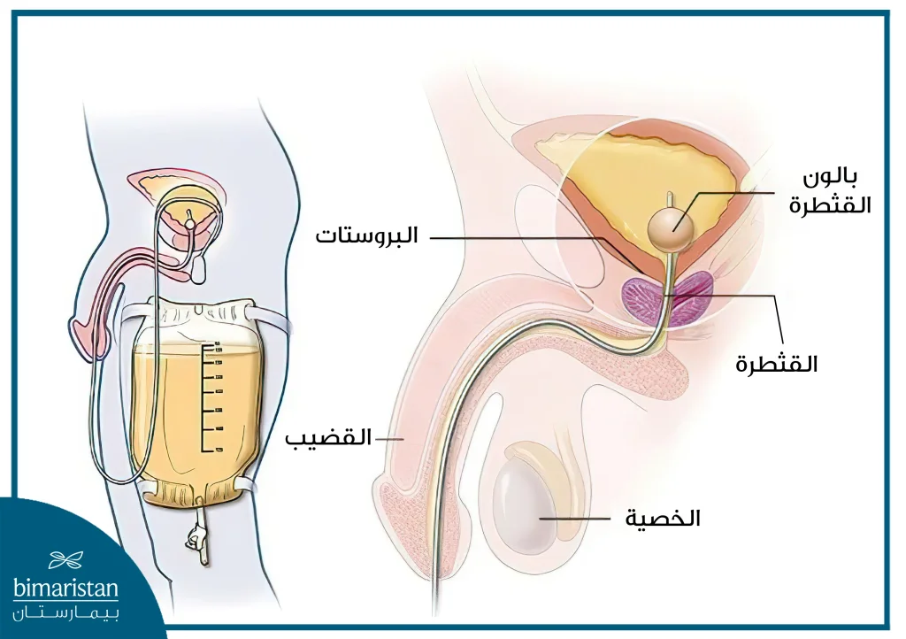 صورة توضح تركيب قثطرة بولية من أجل علاج المثانة العصبية