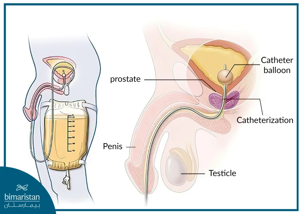 Image Showing The Placement Of A Urinary Catheter For The Treatment Of Neurogenic Bladder