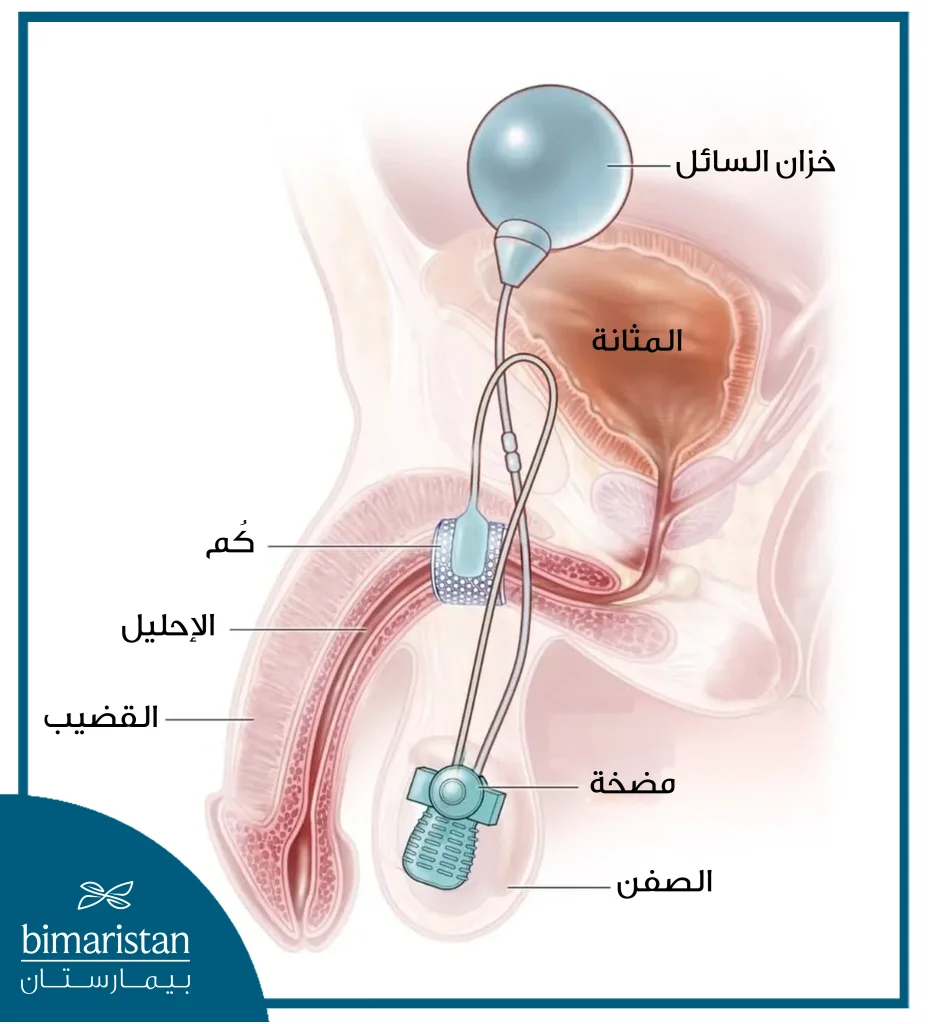 صورة توضح علاج المثانة العصبية جراحياً عبر تركيب معصرة احليل صناعية