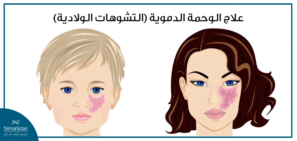 علاج الوحمة الدموية (التشوهات الولادية)