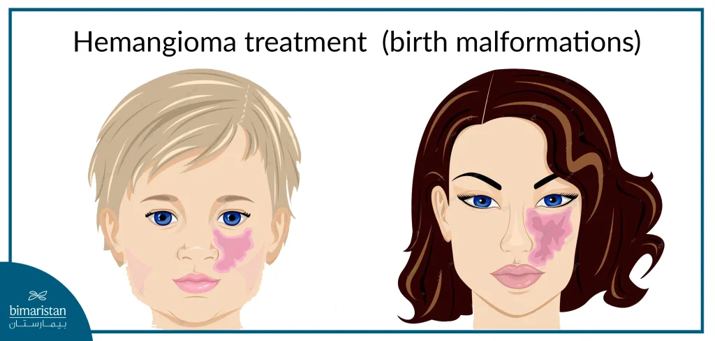 Treatment Of Hemangioma (Congenital Malformation)