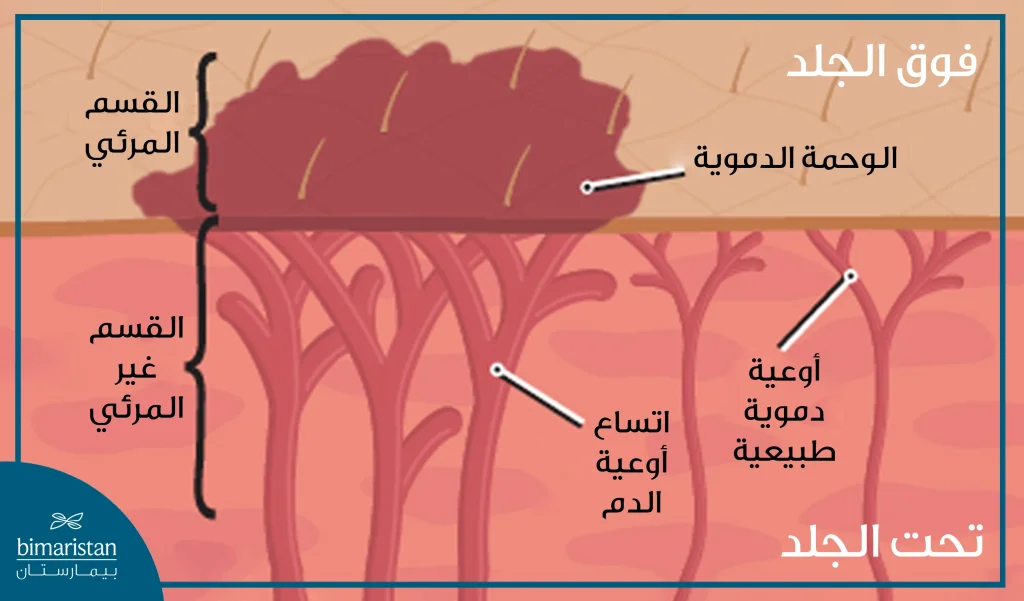 صورة تبين الوحمة الدموية ومكوناتها تحت الجلد وفوق الجلد