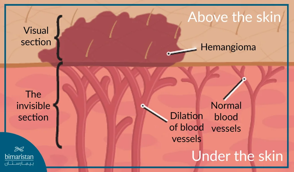 Image Showing A Hemangioma And Its Components Under The Skin And Above The Skin