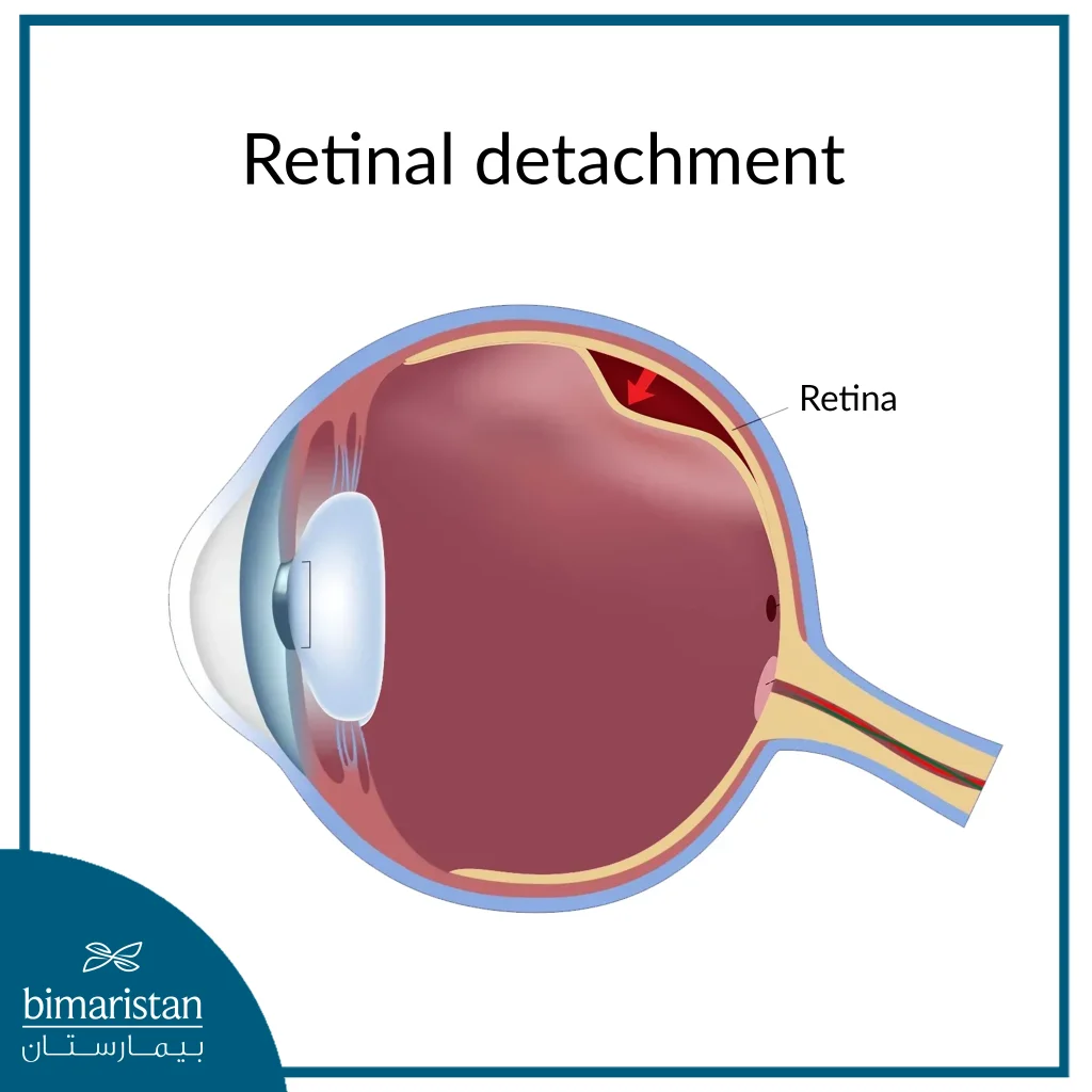 Image Showing Retinal Detachment