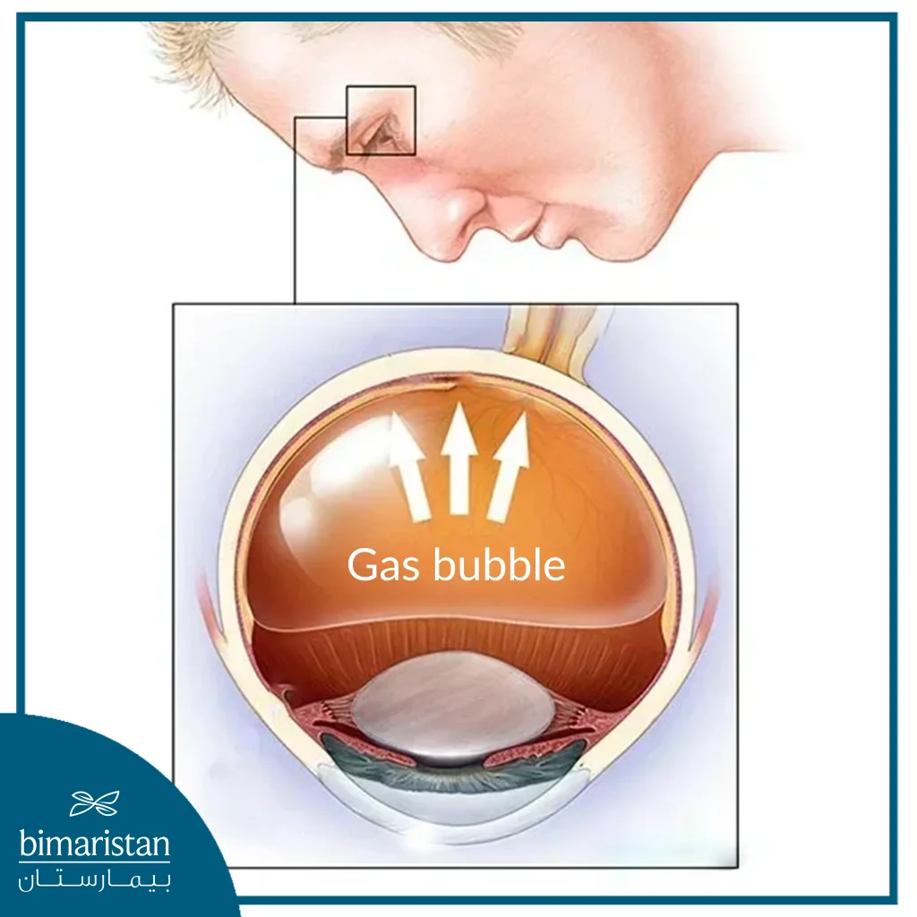 Image Showing The Head Position When Using Gas To Treat Retinal Detachment.