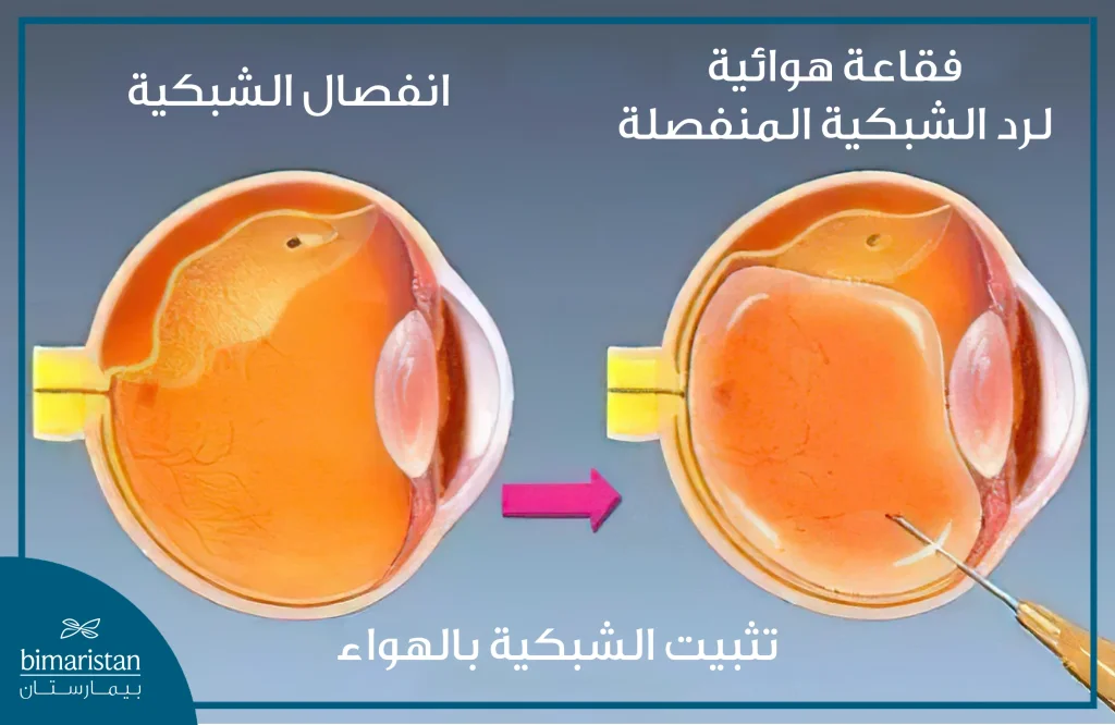 صورة توضح علاج انفصال الشبكية عبر تثبيت الشبكية بالهواء