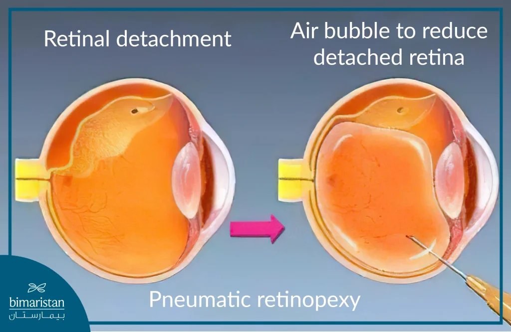 Image Showing The Treatment Of Retinal Detachment By Pneumatic Retinal Fixation.