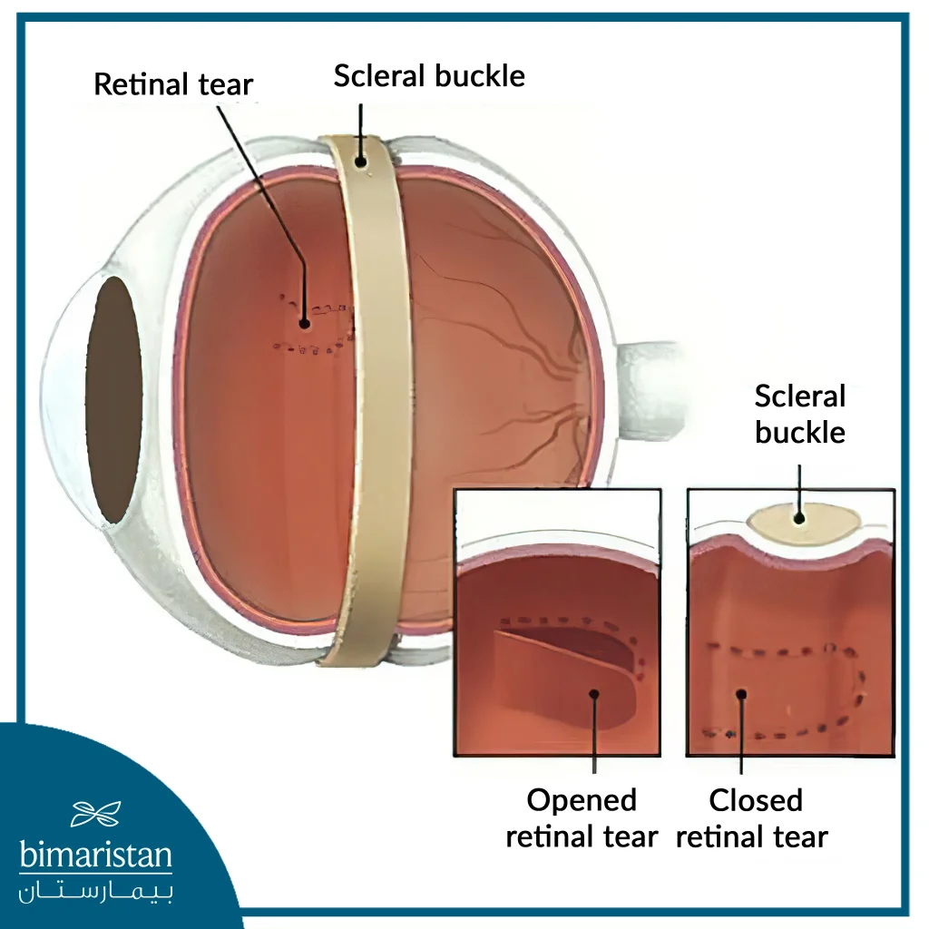 Image Showing The Treatment Of Retinal Detachment By Scleral Plication.