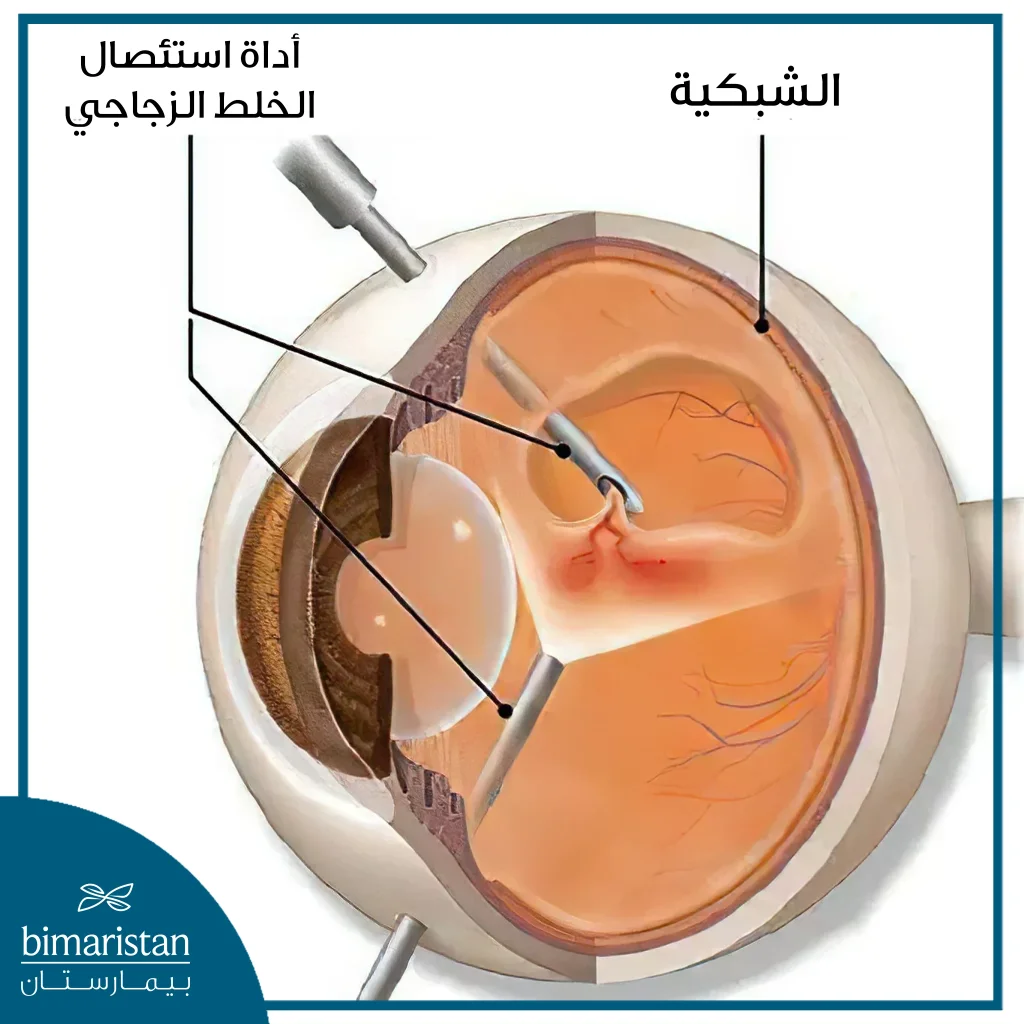 صورة توضح علاج انفصال الشبكية عبر استئصال الخلط الزجاجي