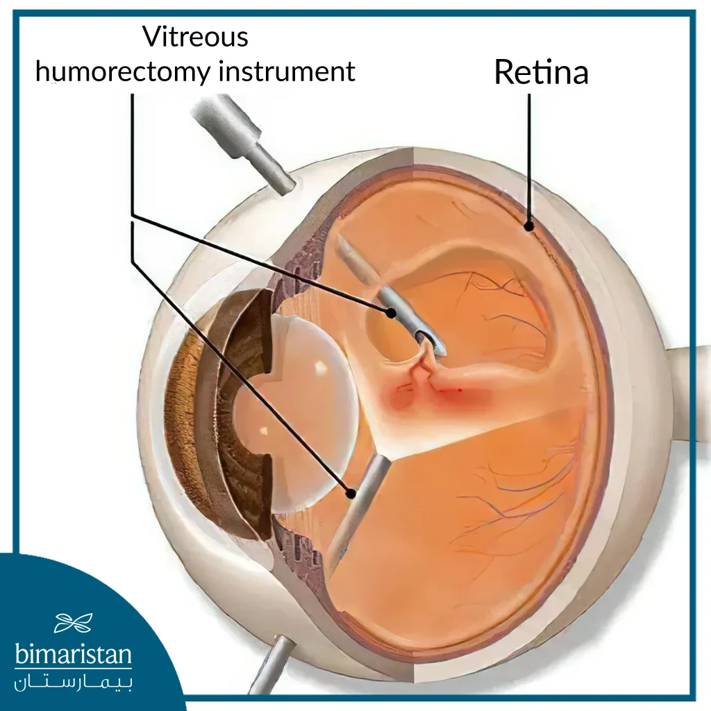 Image Showing Treatment Of Retinal Detachment By Vitrectomy