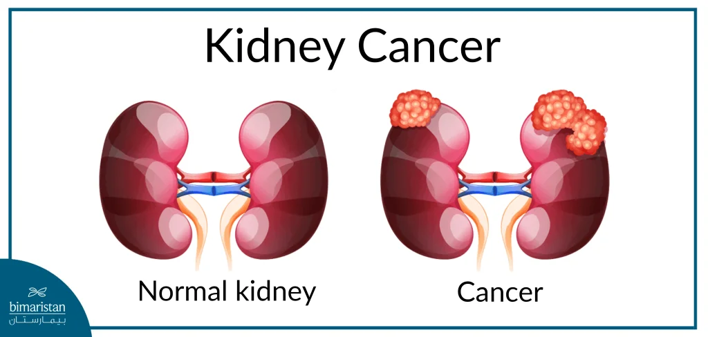 Kidney Cancer And The Difference From The Normal Kidney Shape