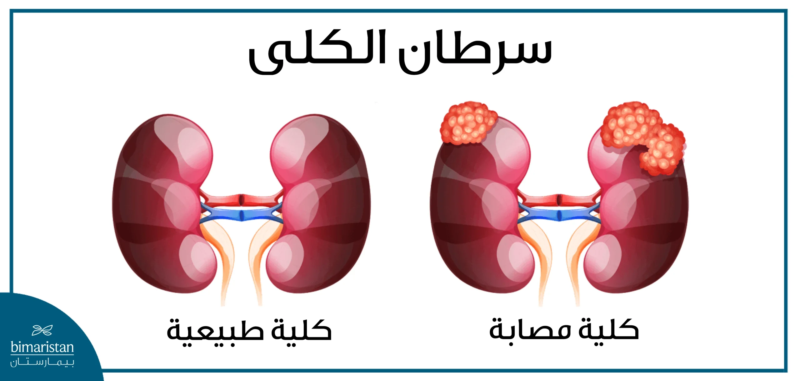 سرطان الكلى والفرق عن شكل الكلية الطبيعي