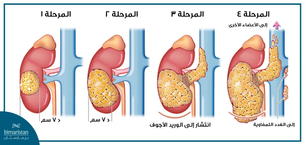 مراحل سرطان الكلية