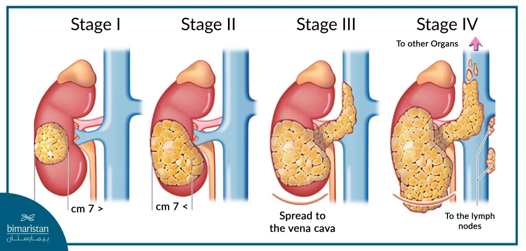 Stages Of Kidney Cancer