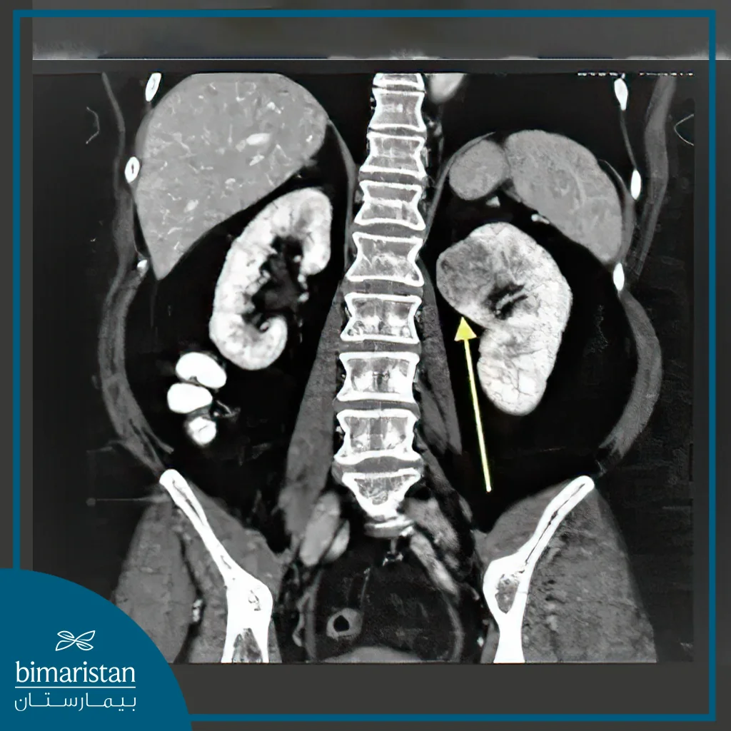 Mri Shows A Mass In The Left Kidney.