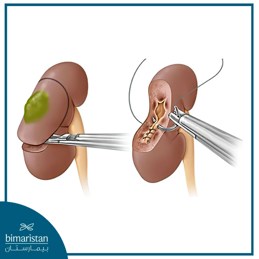 In A Partial Nephrectomy, The Surgeon Removes Only The Part Of The Kidney That Contains The Tumor.