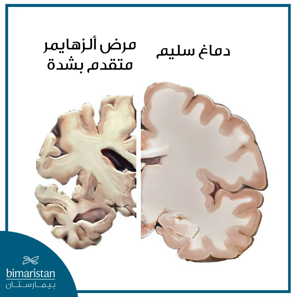 صورة توضح ضمور المادة الدماغية بسبب مرض الزهايمر