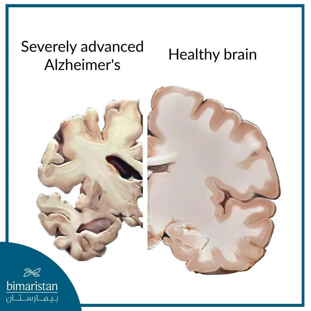 Image showing brain atrophy due to Alzheimer's disease