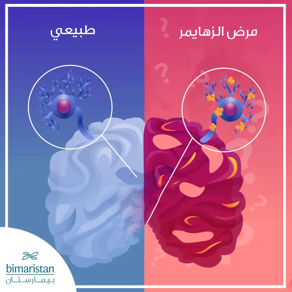 صورة توضح آلية حدوث مرض الزهايمر وتراكم بروتينات الأميلوئيد حول الخلايا العصبية