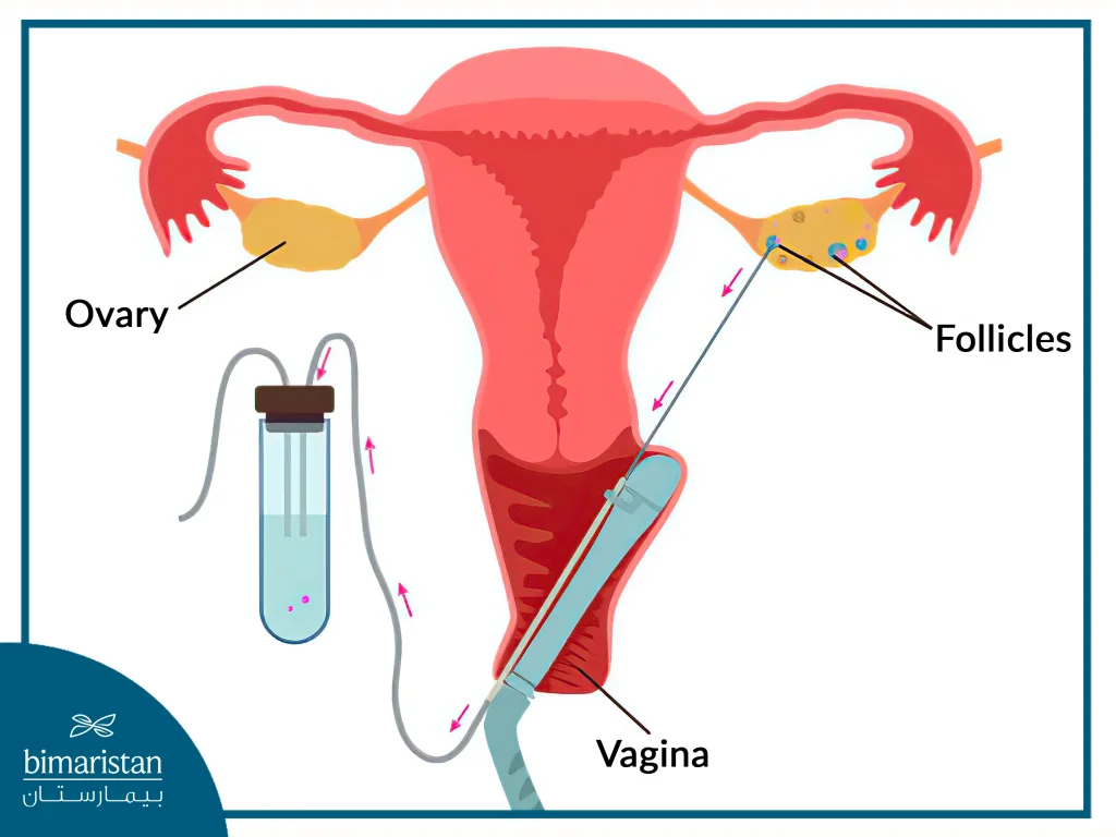 How To Retrieve Eggs In Ivf With Pictures