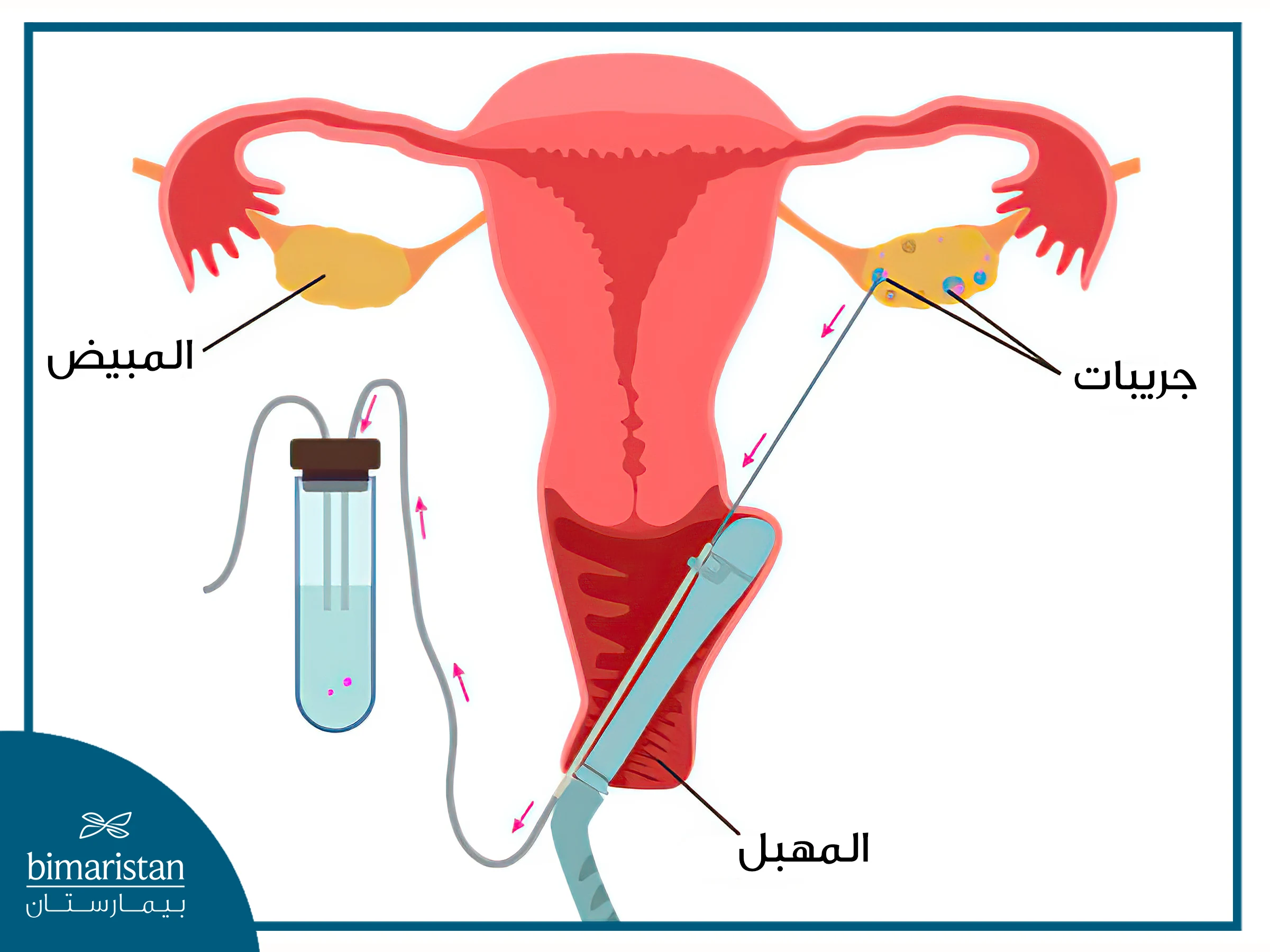 سحب البويضات في عملية أطفال الأنابيب في تركيا