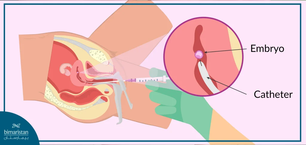 Ivf Implantation Method In Turkey