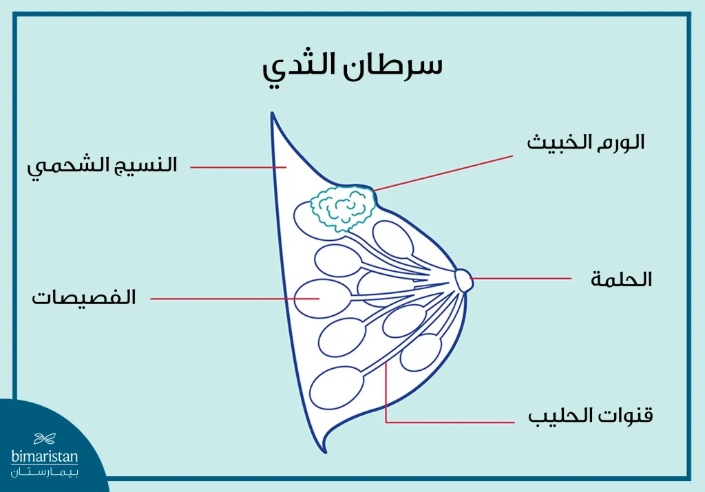 شكل الثدي المصاب بالسرطان