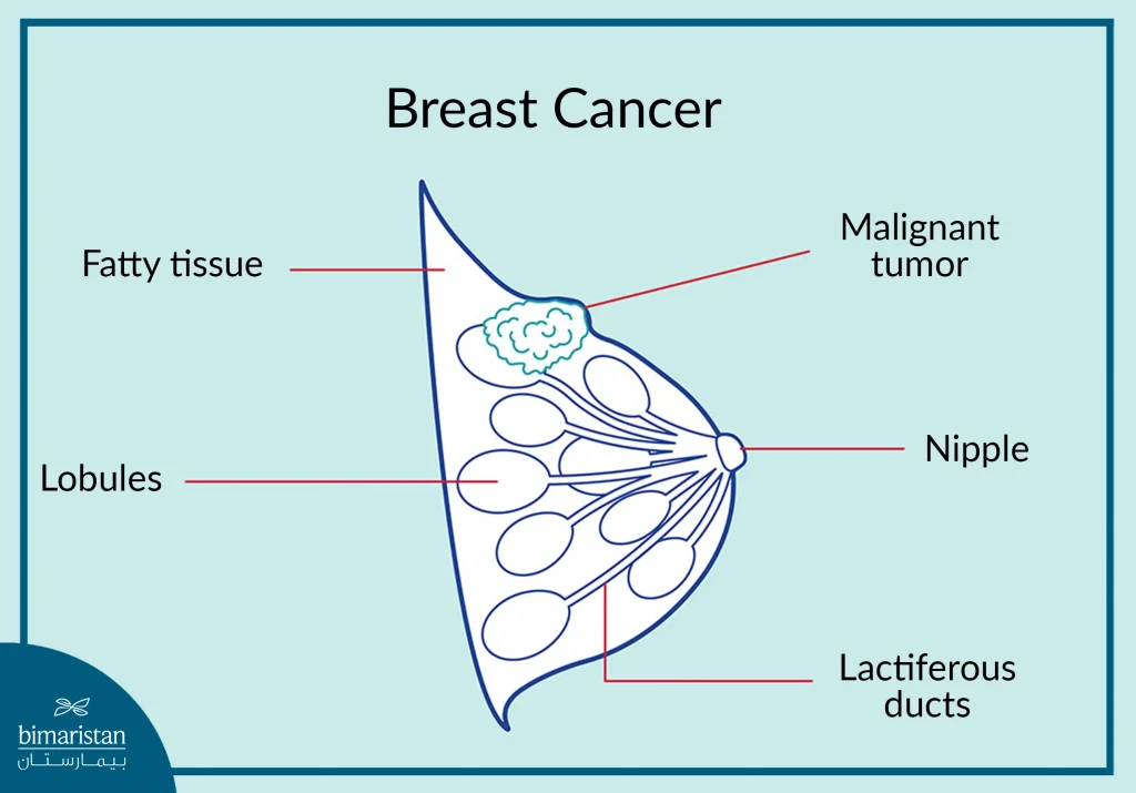 Breast Cancer Shape