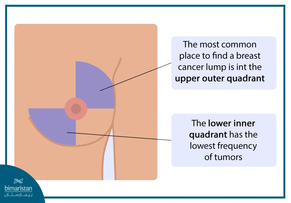 Where Is Breast Cancer Lump Located With Pictures