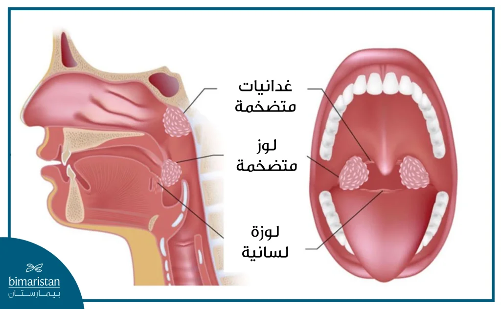 كثيراً ما يترافق تضخم اللوزتين مع تضخم الناميات (الغدانيات)
