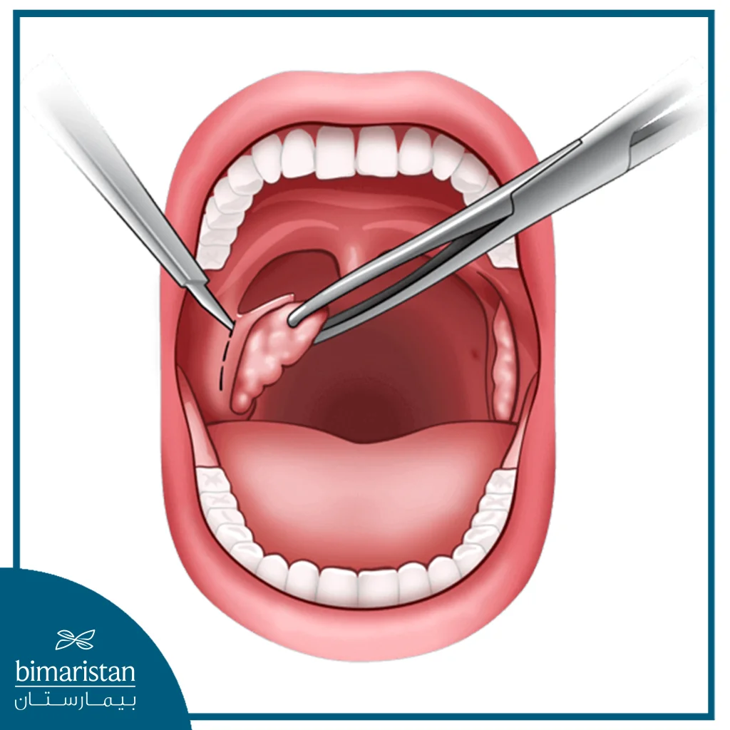 During A Tonsillectomy, The Surgeon Removes The Enlarged Tonsils From Their Surroundings.