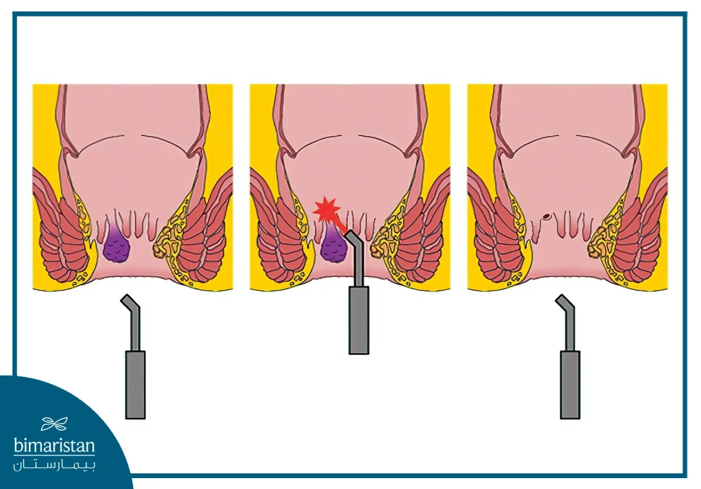 A Plastic Piece Is Placed To Keep The Anus Open And The Surgeon Then Inserts The Laser Probe