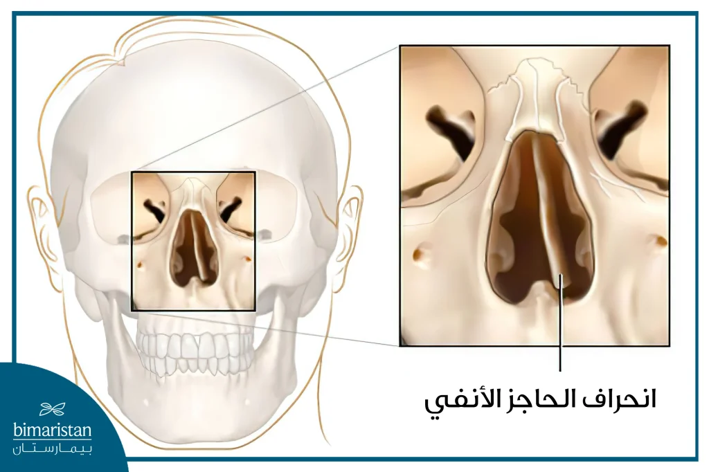 ينحرف الحاجز الأنفي عن الخط الناصف