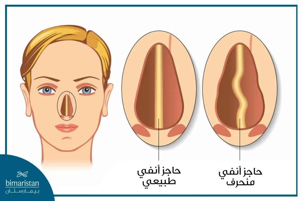 صورة لحاجز أنفي طبيعي وحاجز أنفي منحرف