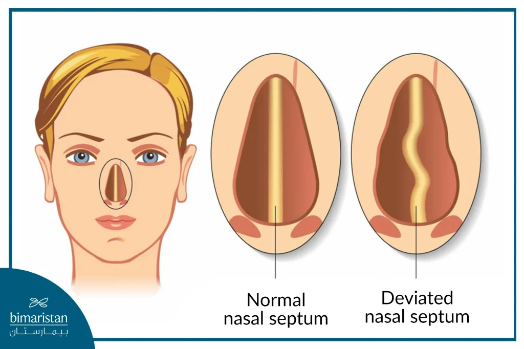 Picture Of A Normal Nasal Septum And A Deviated Nasal Septum