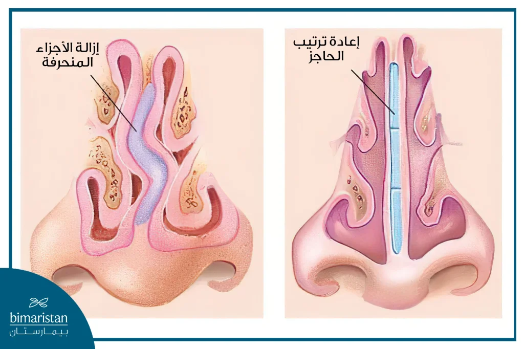 تتم إزالة الأجزاء المنحرفة ومن ثم إعادة ترتيب الحاجز