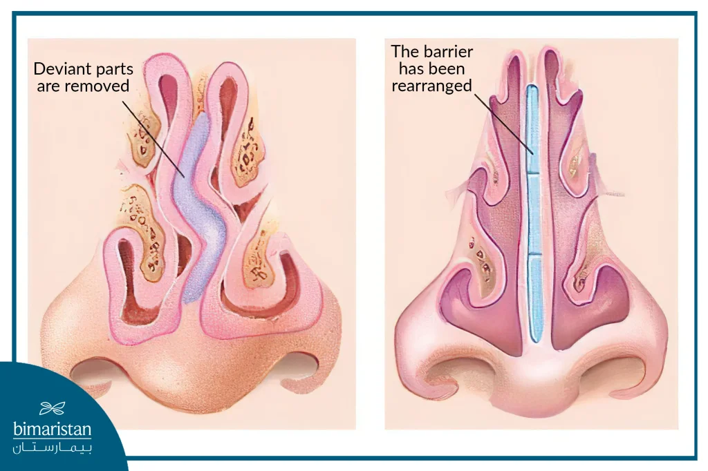 The Deviated Parts Are Removed And The Septum Is Then Realigned