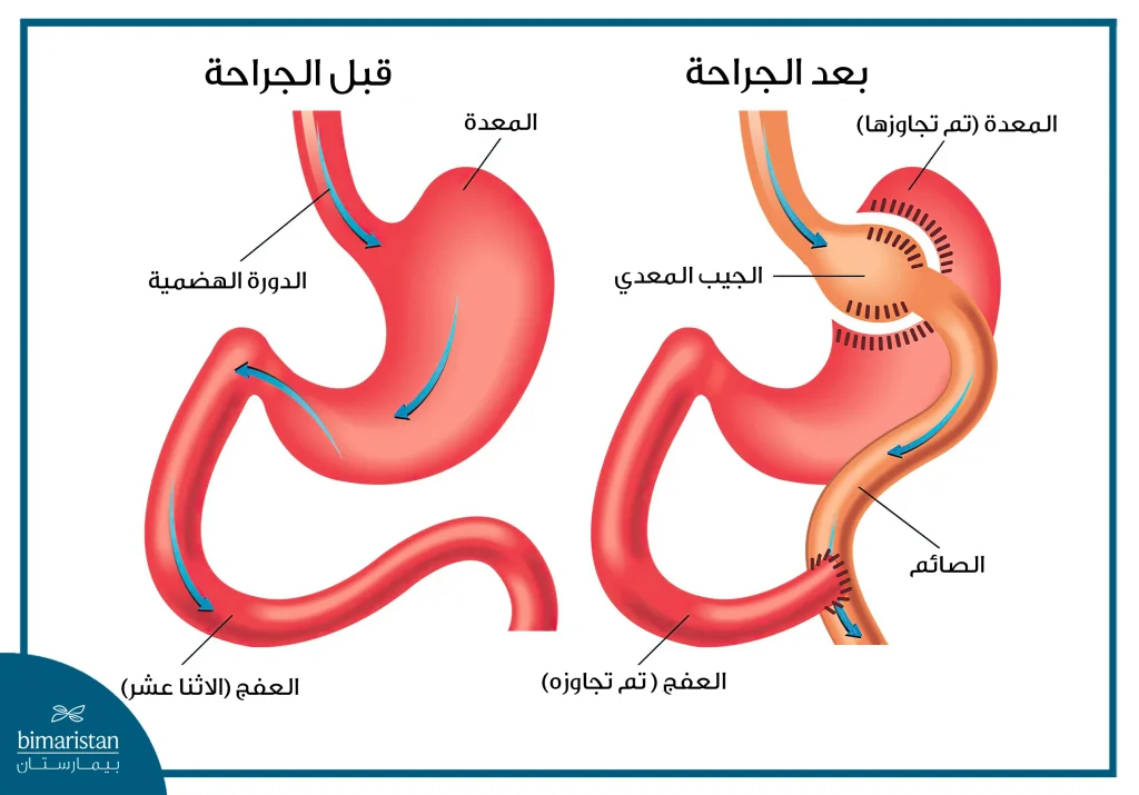 عملية تحويل المسار المصغر قبل وبعد