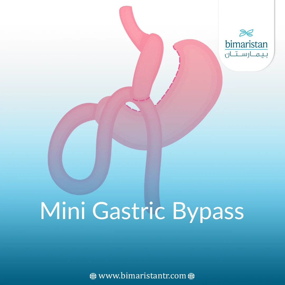 Mini Gastric Bypass in Turkey