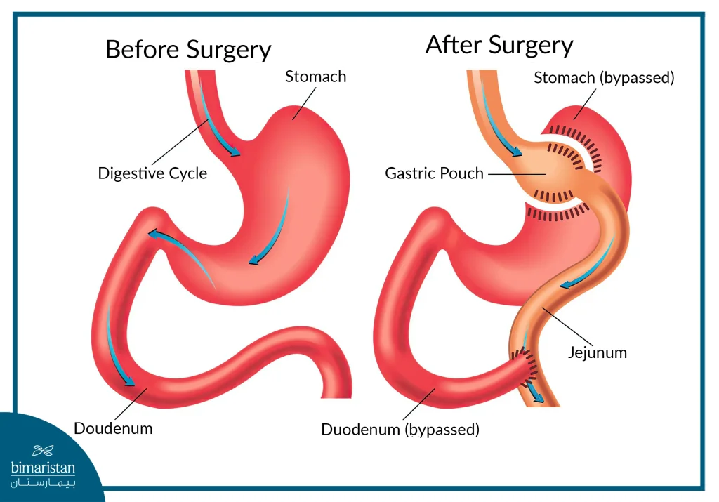 Mini Gastric Bypass Before And After