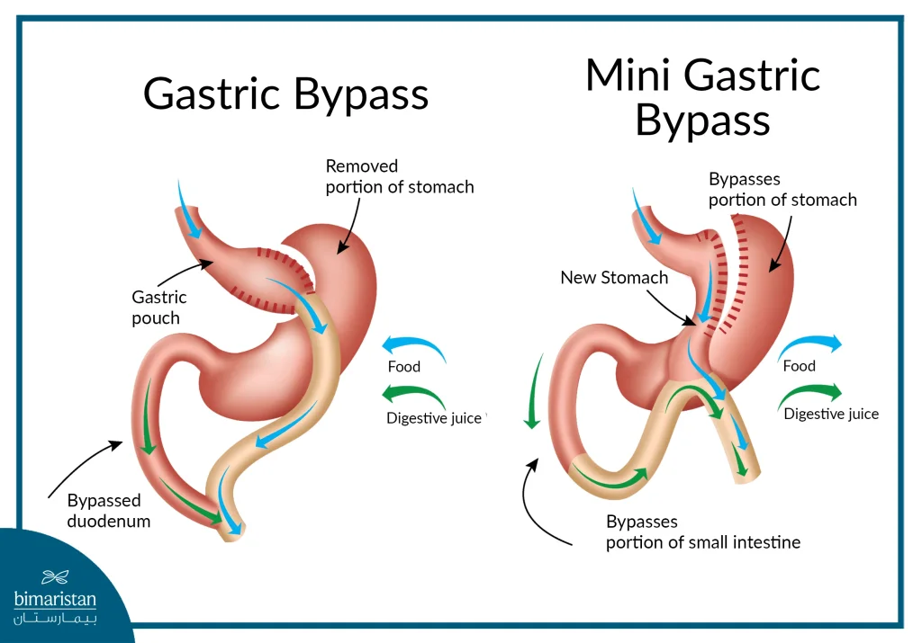 The Difference Between Mini Gastric Bypass And Traditional Gastric Bypass