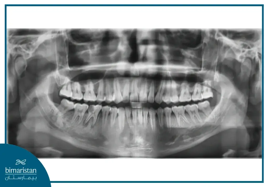 X-Ray Before Extraction