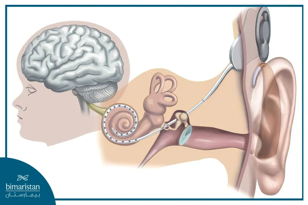 How Do Cochlear Implants Work And How Do Them Differ From External Hearing Aids?