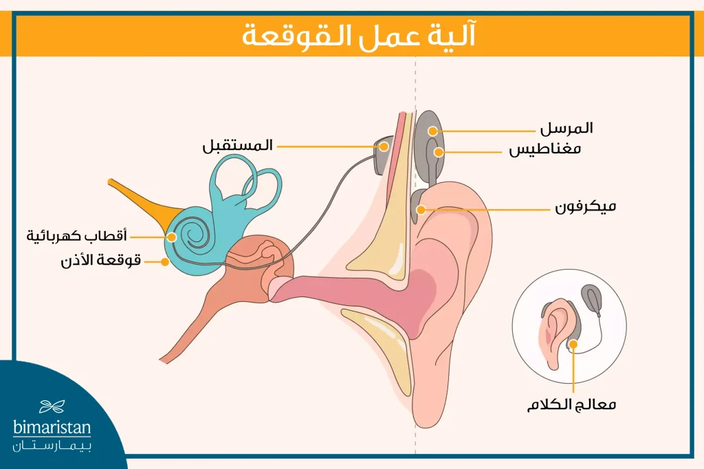 صورة توضح آلية عمل القوقعة الالكترونية