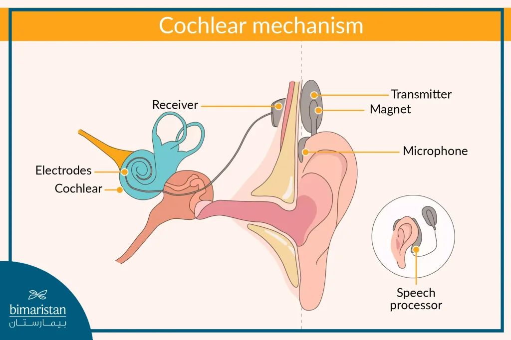 Image Showing How The Cochlear Implants Work